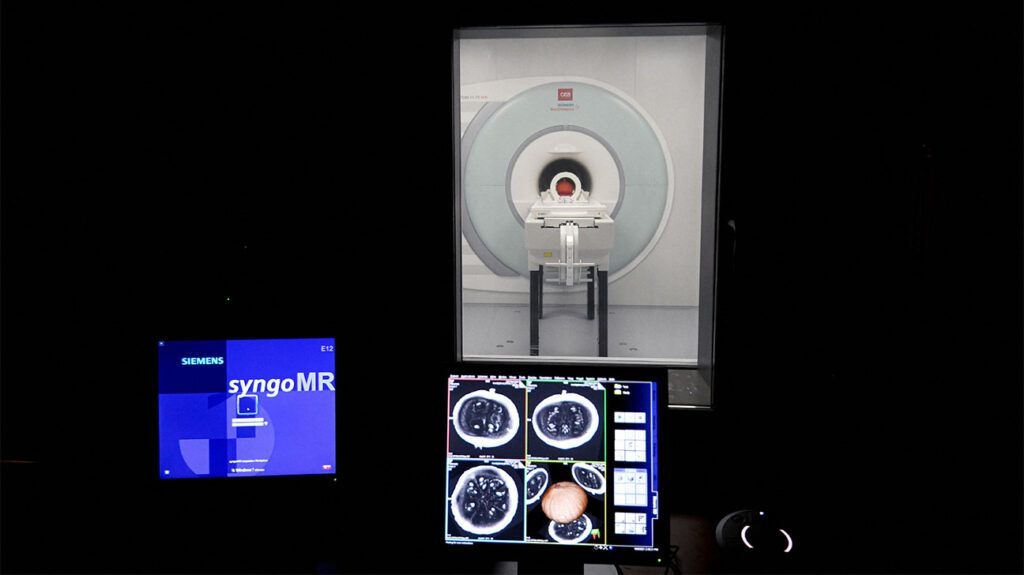 Precision MRI Reveals That Brainstem Damage May Account for Long COVID Symptoms